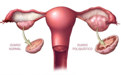 Síndrome de ovario poliquístico