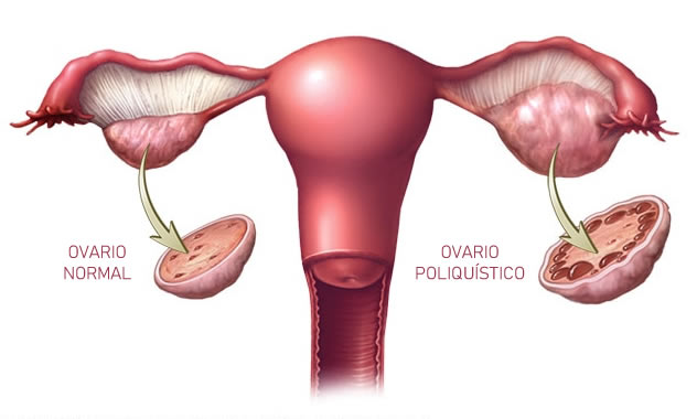 Síndrome de ovario poliquístico